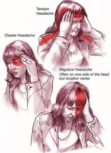 Penyebab Sakit Kepala Sebelah